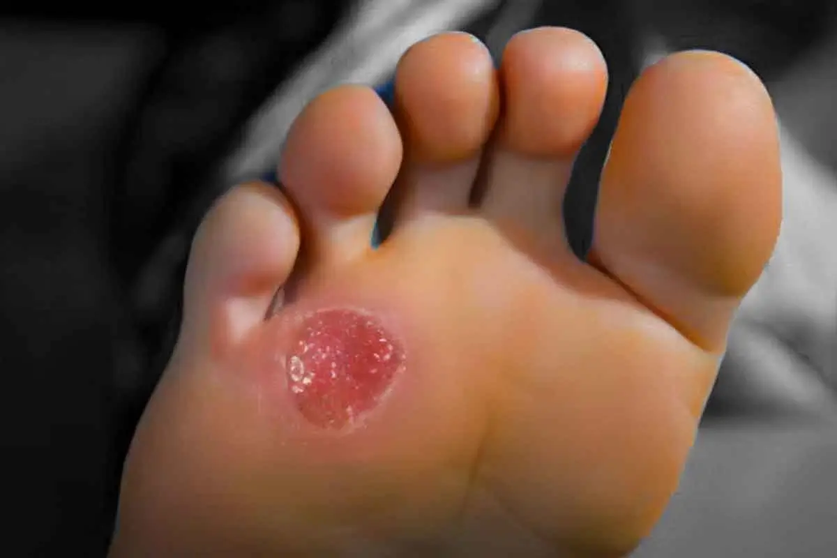 Diabetic Wound image